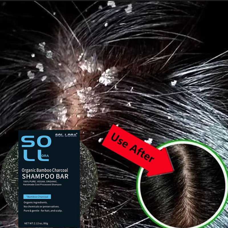 Hair Care Dandruff - صابون سريع مضاد للقشرة لعلاج الشعر،