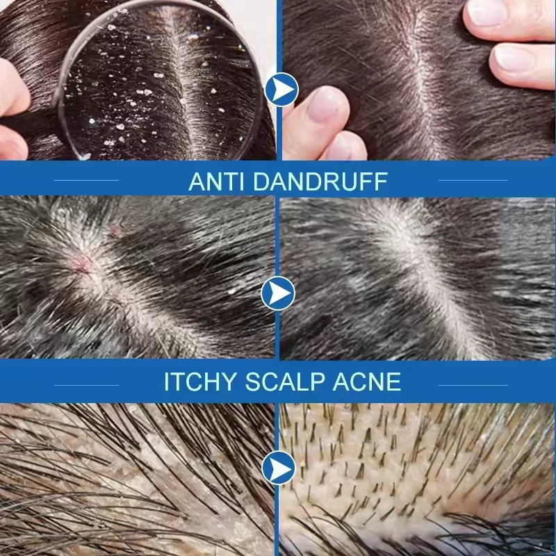 صابون سريع مضاد للقشرة لعلاج ا - مراجعة Hair Care Dandruff وسعره
