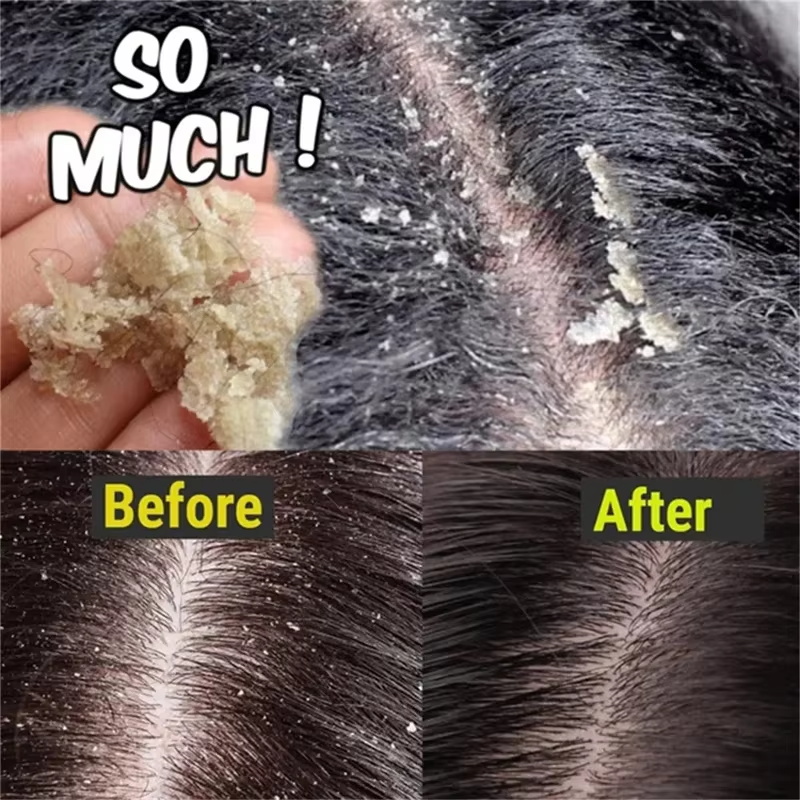 صابون سريع مضاد للقشرة لعلاج ا - مراجعة Hair Care Dandruff وسعره